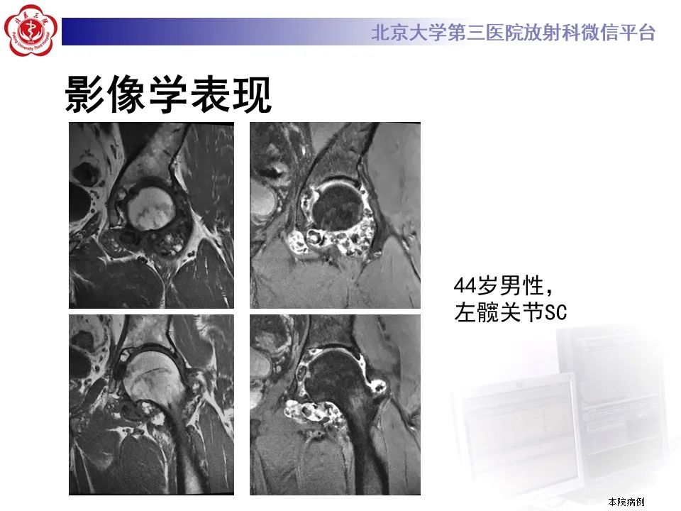 影像PPT - 【PPT】滑膜软骨瘤病-34