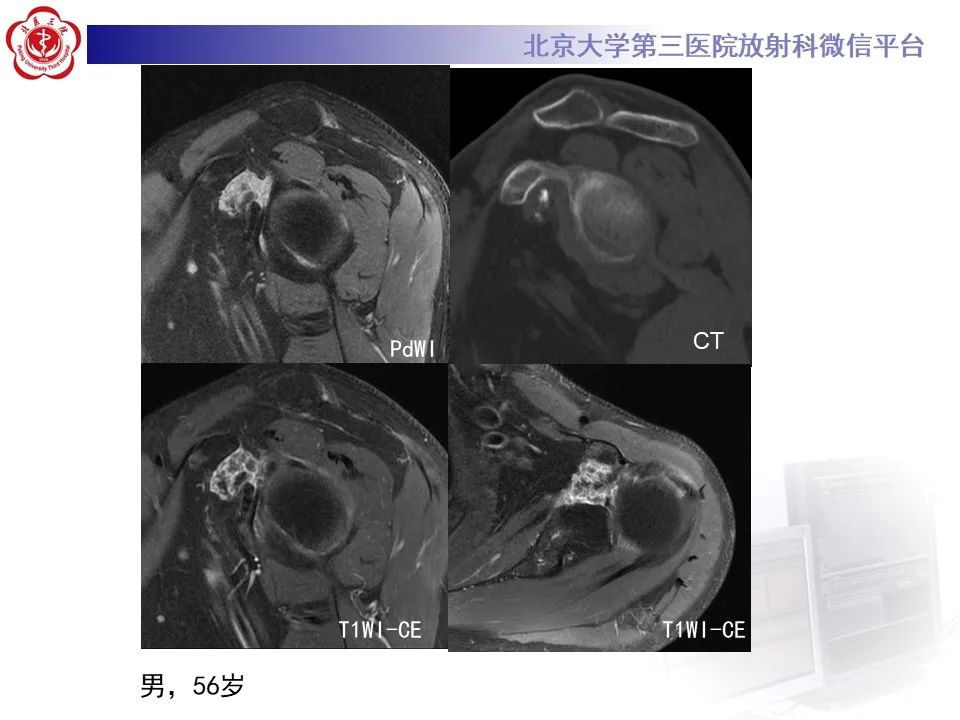 影像PPT - 【PPT】滑膜软骨瘤病-35