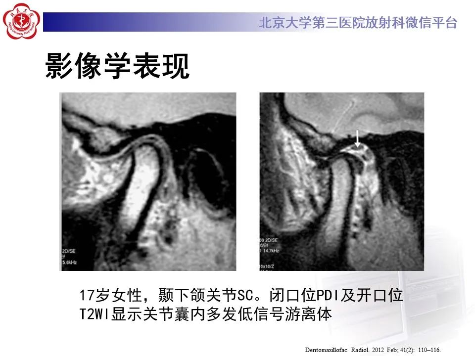 影像PPT - 【PPT】滑膜软骨瘤病-36