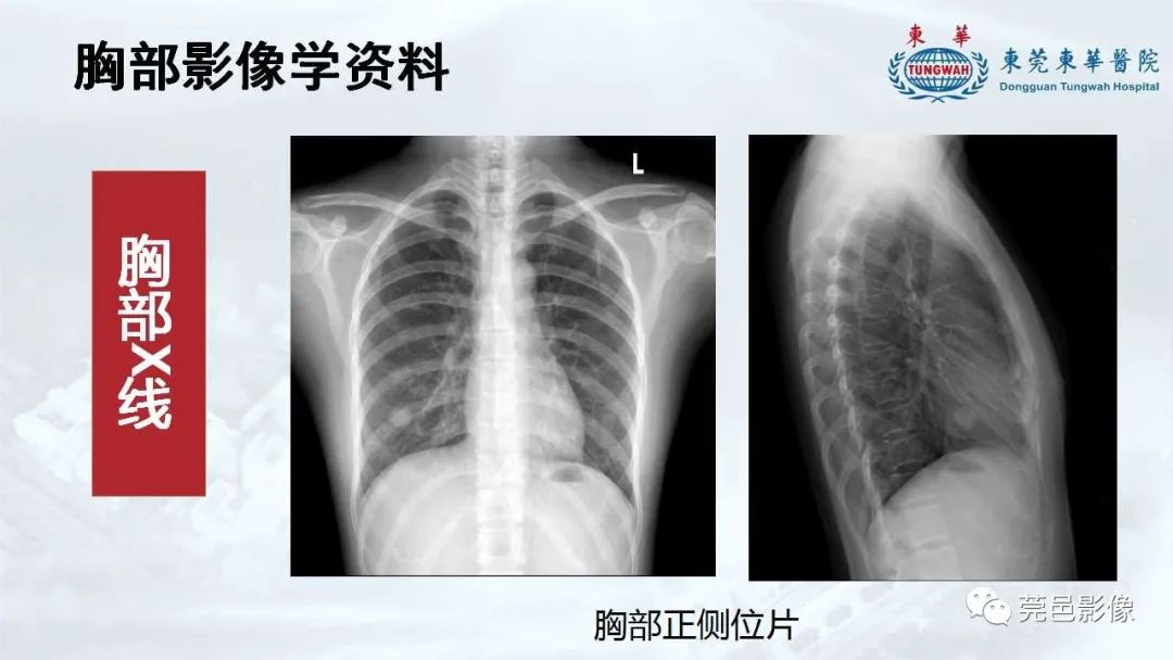 影像PPT - 【病例】一例肺良性转移性平滑肌瘤及文献复习-7