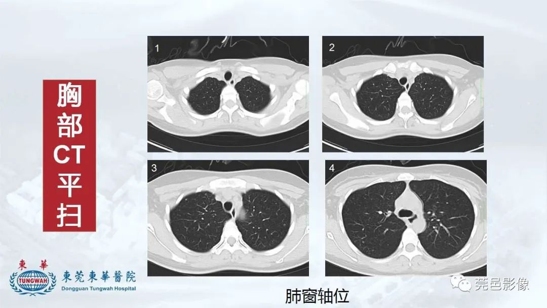 影像PPT - 【病例】一例肺良性转移性平滑肌瘤及文献复习-8