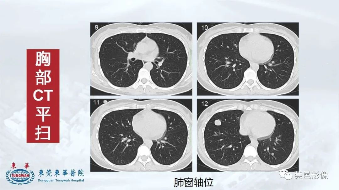 影像PPT - 【病例】一例肺良性转移性平滑肌瘤及文献复习-10