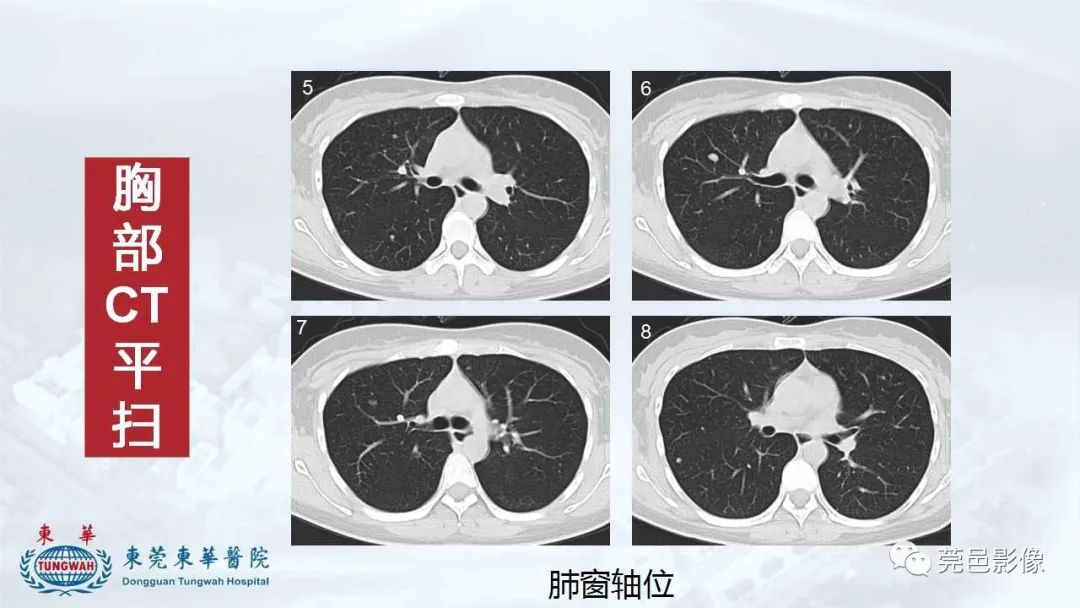 影像PPT - 【病例】一例肺良性转移性平滑肌瘤及文献复习-9