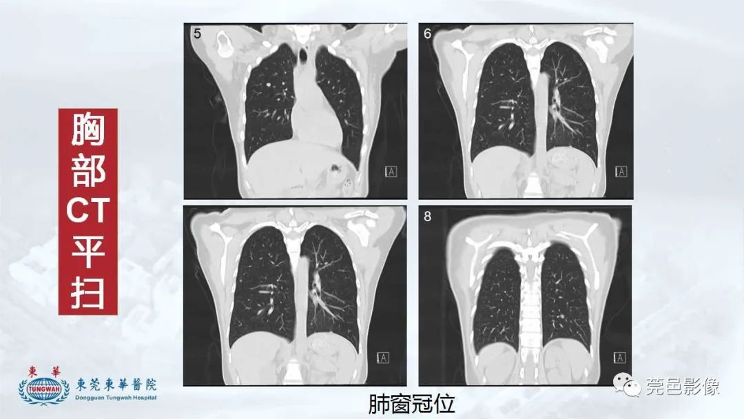 影像PPT - 【病例】一例肺良性转移性平滑肌瘤及文献复习-13