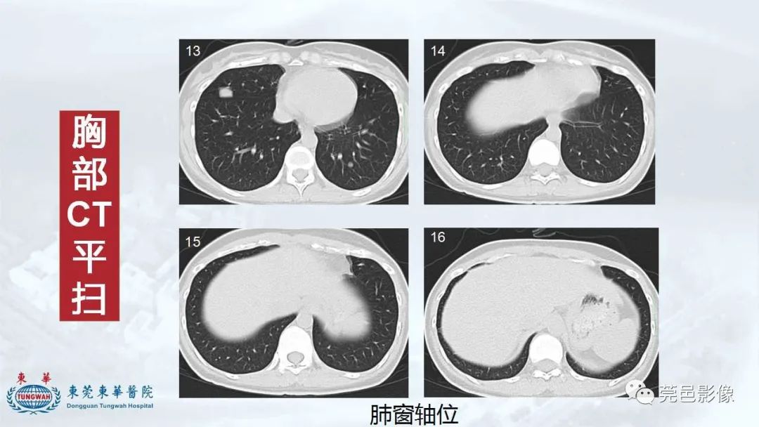 影像PPT - 【病例】一例肺良性转移性平滑肌瘤及文献复习-11