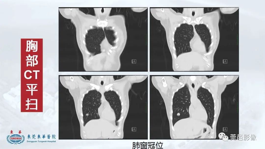 影像PPT - 【病例】一例肺良性转移性平滑肌瘤及文献复习-12