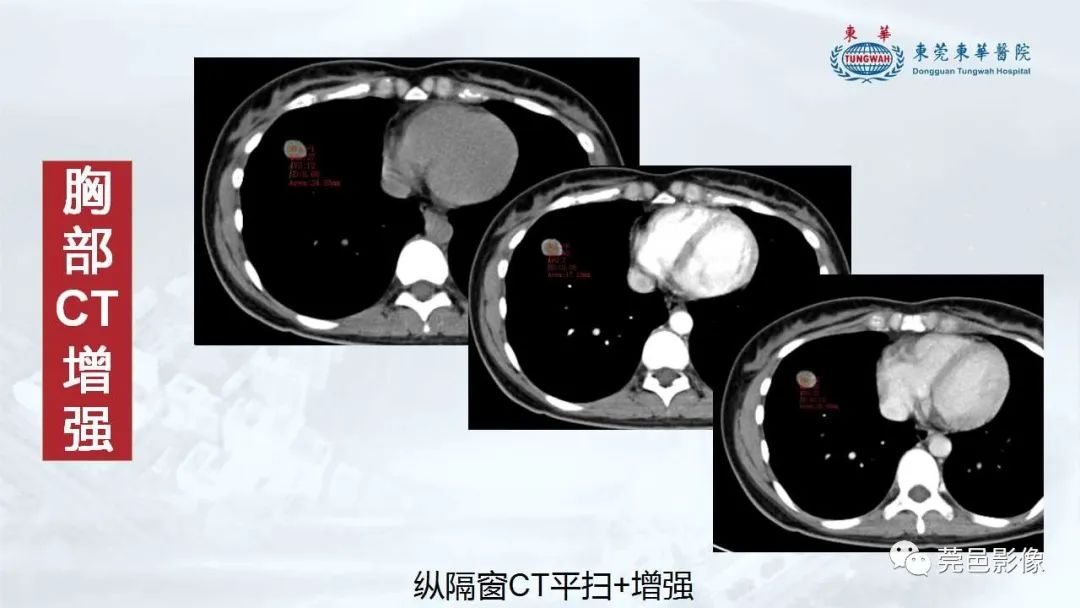 影像PPT - 【病例】一例肺良性转移性平滑肌瘤及文献复习-14