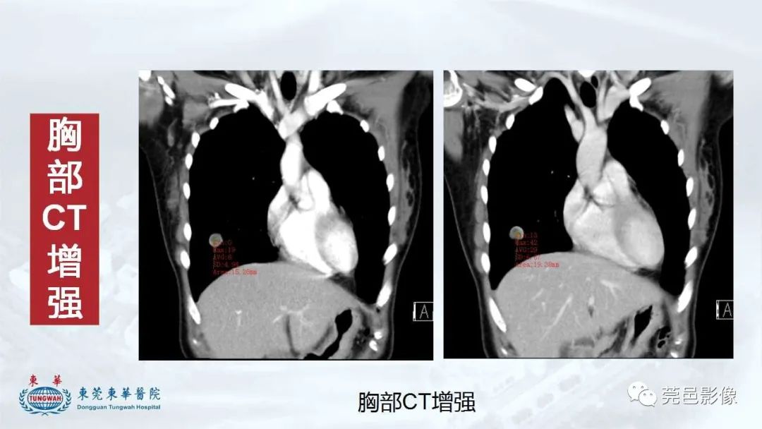 影像PPT - 【病例】一例肺良性转移性平滑肌瘤及文献复习-15