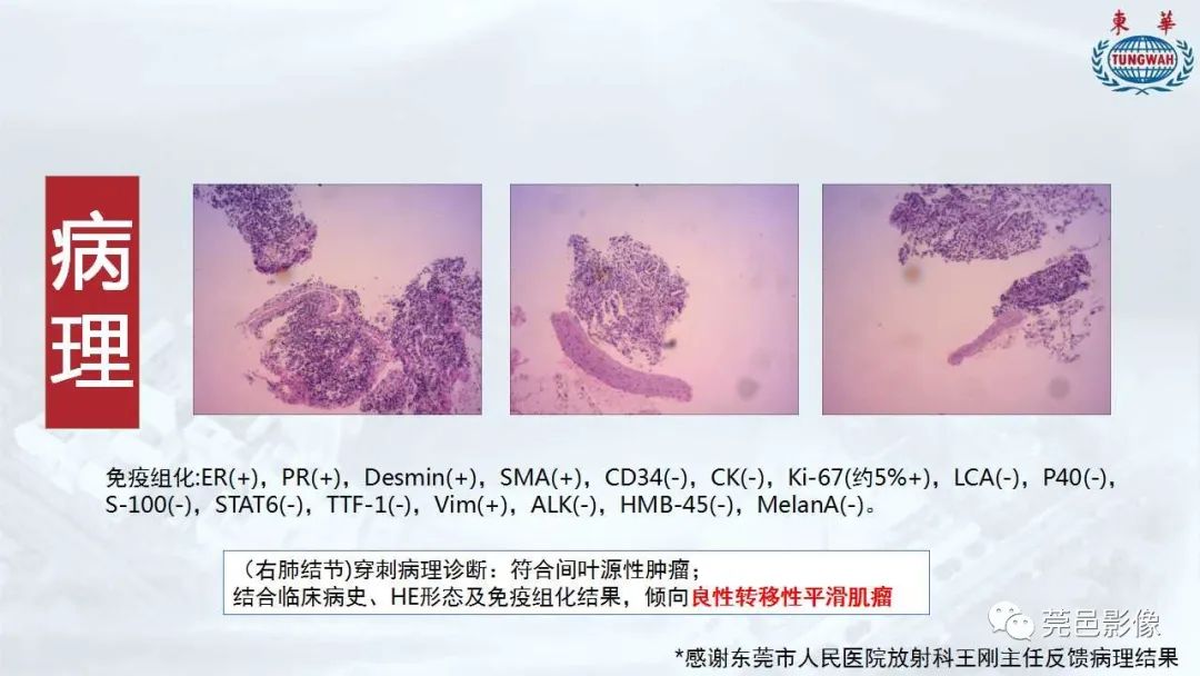 影像PPT - 【病例】一例肺良性转移性平滑肌瘤及文献复习-17
