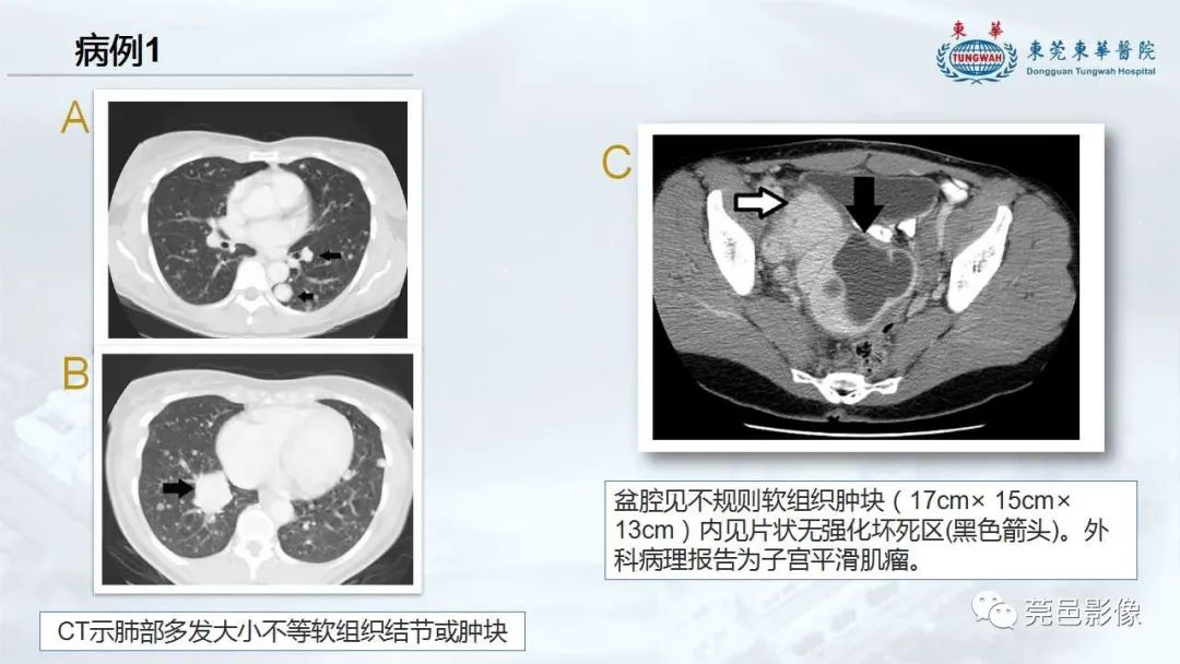 影像PPT - 【病例】一例肺良性转移性平滑肌瘤及文献复习-22