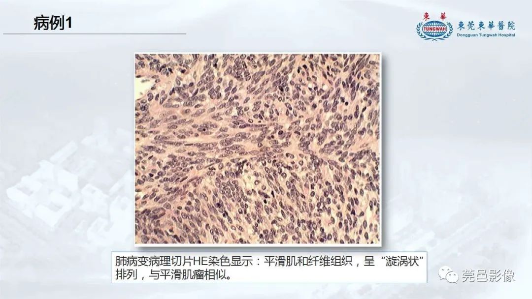 影像PPT - 【病例】一例肺良性转移性平滑肌瘤及文献复习-23