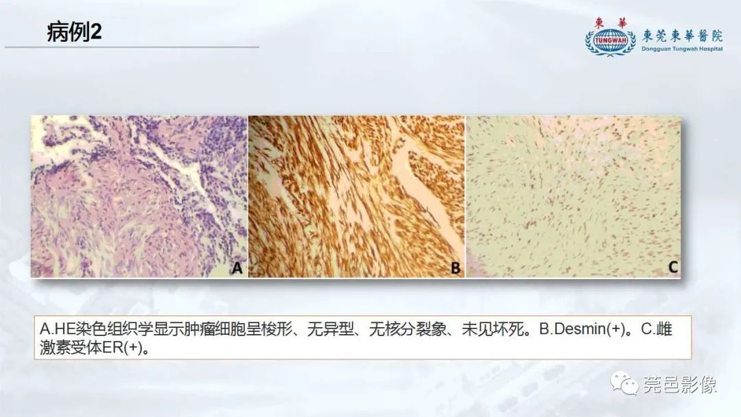 影像PPT - 【病例】一例肺良性转移性平滑肌瘤及文献复习-25