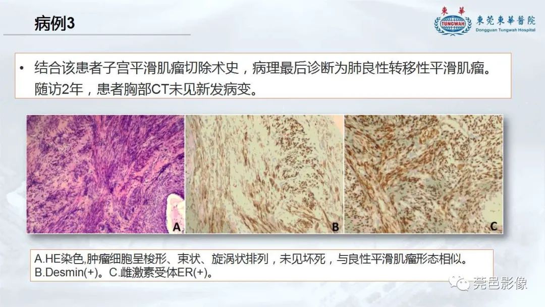 影像PPT - 【病例】一例肺良性转移性平滑肌瘤及文献复习-27