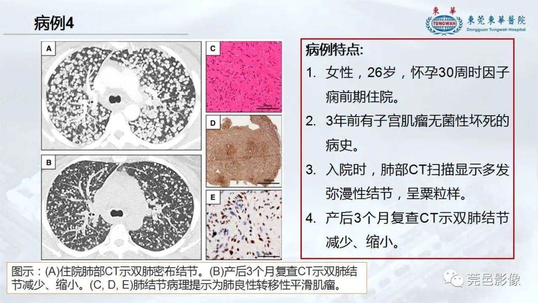 影像PPT - 【病例】一例肺良性转移性平滑肌瘤及文献复习-28