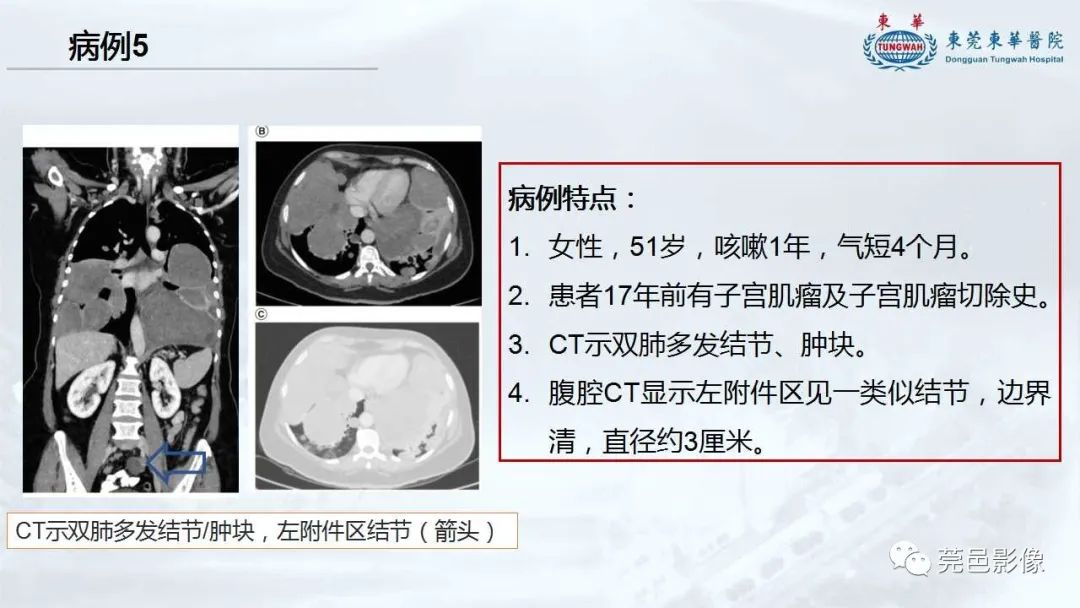 影像PPT - 【病例】一例肺良性转移性平滑肌瘤及文献复习-29