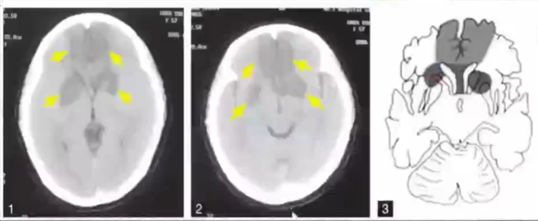 影像PPT - 急性脑梗死临床及其MRI影像特点-3 影像PPT - 急性脑梗死临床及其MRI影像特点-3