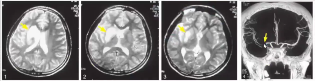 影像PPT - 急性脑梗死临床及其MRI影像特点-10 影像PPT - 急性脑梗死临床及其MRI影像特点-10