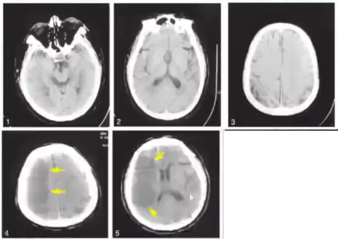 影像PPT - 急性脑梗死临床及其MRI影像特点-9 影像PPT - 急性脑梗死临床及其MRI影像特点-9