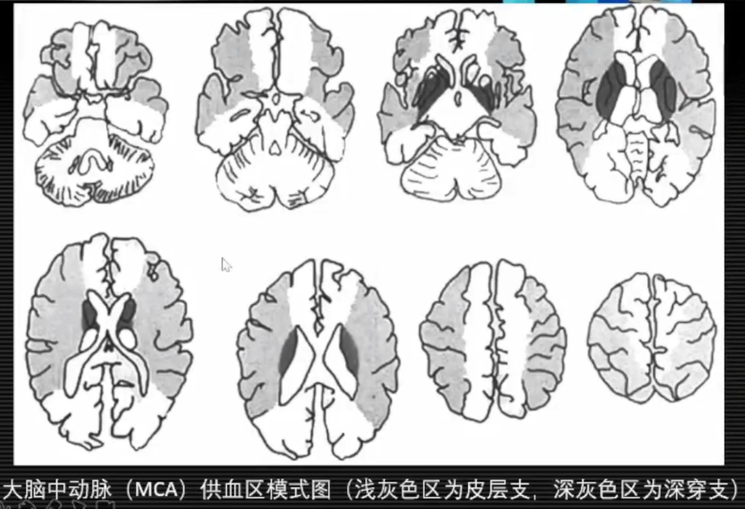 影像PPT - 急性脑梗死临床及其MRI影像特点-12 影像PPT - 急性脑梗死临床及其MRI影像特点-12