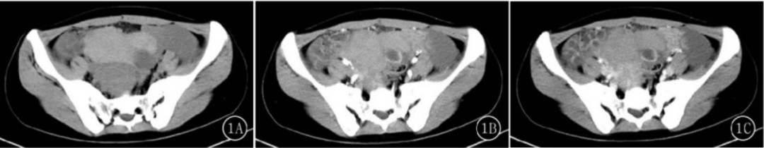 影像PPT - 卵巢良性囊性病变的 CT、MRI 表现-2 影像PPT - 卵巢良性囊性病变的 CT、MRI 表现-2