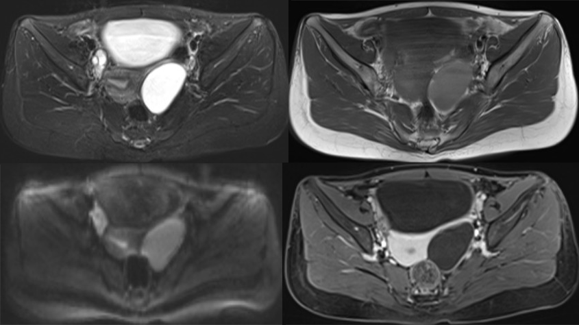 影像PPT - 卵巢良性囊性病变的 CT、MRI 表现-1 影像PPT - 卵巢良性囊性病变的 CT、MRI 表现-1