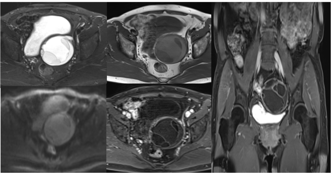 影像PPT - 卵巢良性囊性病变的 CT、MRI 表现-5 影像PPT - 卵巢良性囊性病变的 CT、MRI 表现-5