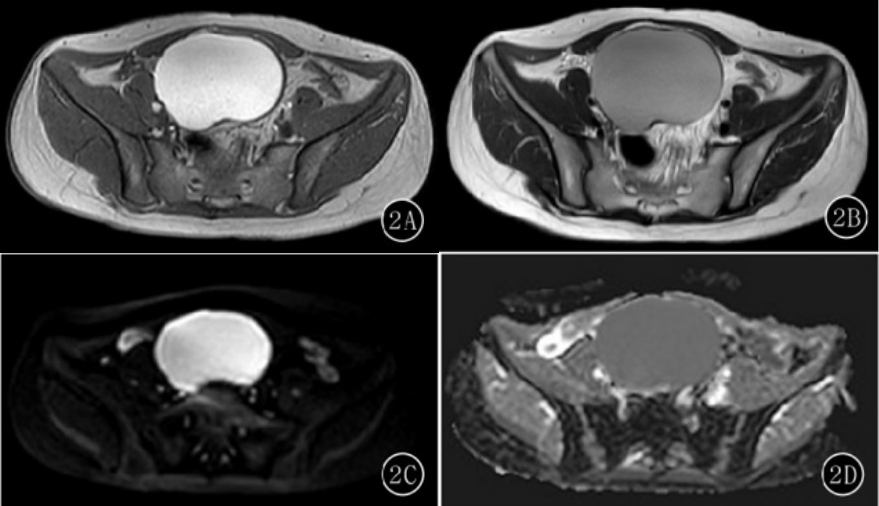 影像PPT - 卵巢良性囊性病变的 CT、MRI 表现-3 影像PPT - 卵巢良性囊性病变的 CT、MRI 表现-3