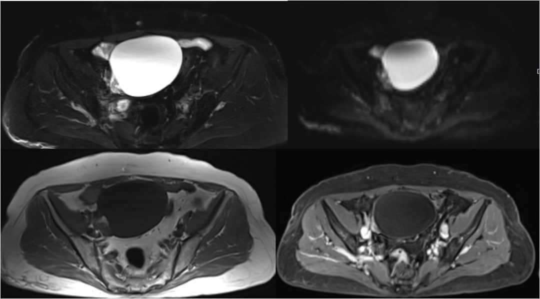 影像PPT - 卵巢良性囊性病变的 CT、MRI 表现-4 影像PPT - 卵巢良性囊性病变的 CT、MRI 表现-4