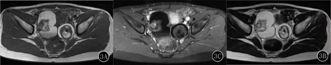 影像PPT - 卵巢良性囊性病变的 CT、MRI 表现-6 影像PPT - 卵巢良性囊性病变的 CT、MRI 表现-6