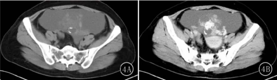 影像PPT - 卵巢良性囊性病变的 CT、MRI 表现-7 影像PPT - 卵巢良性囊性病变的 CT、MRI 表现-7