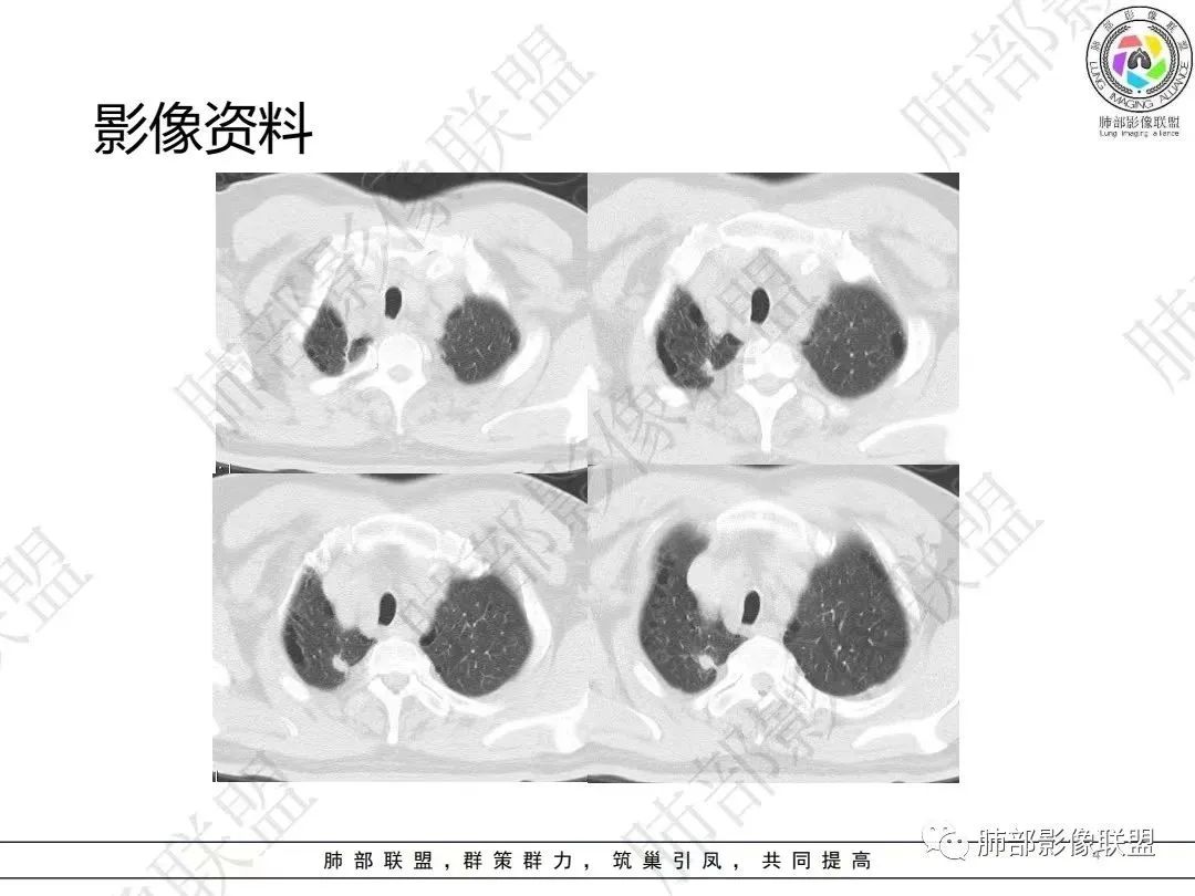 影像PPT - 【病例】大支气管内肿瘤的异类-4 影像PPT - 【病例】大支气管内肿瘤的异类-4
