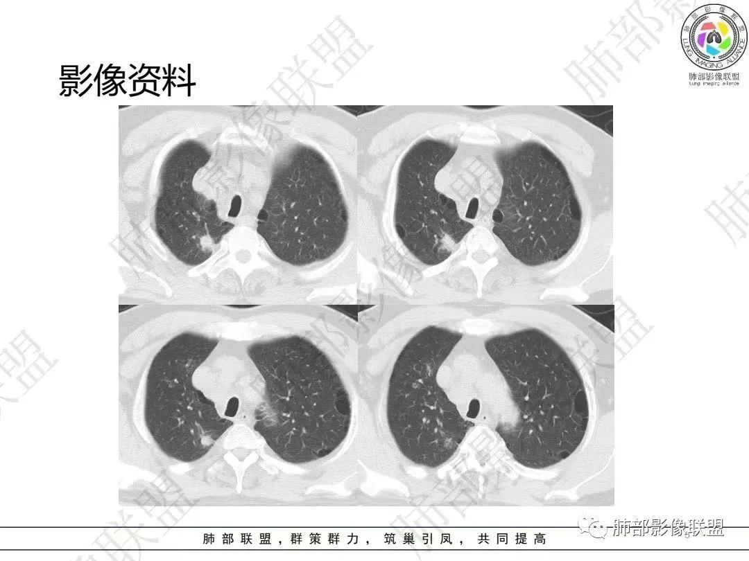 影像PPT - 【病例】大支气管内肿瘤的异类-5 影像PPT - 【病例】大支气管内肿瘤的异类-5
