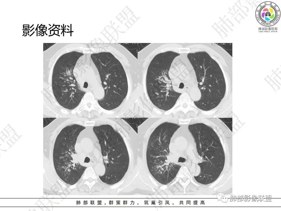 影像PPT - 【病例】大支气管内肿瘤的异类-7 影像PPT - 【病例】大支气管内肿瘤的异类-7