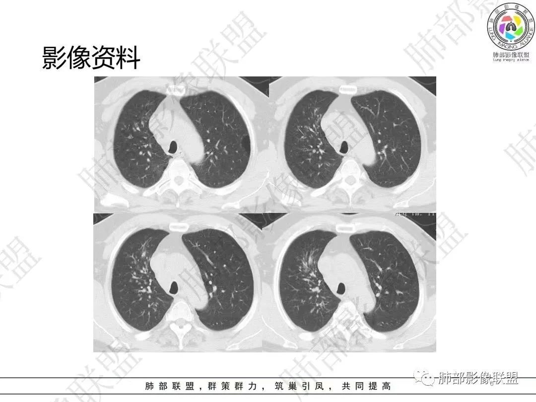 影像PPT - 【病例】大支气管内肿瘤的异类-6 影像PPT - 【病例】大支气管内肿瘤的异类-6