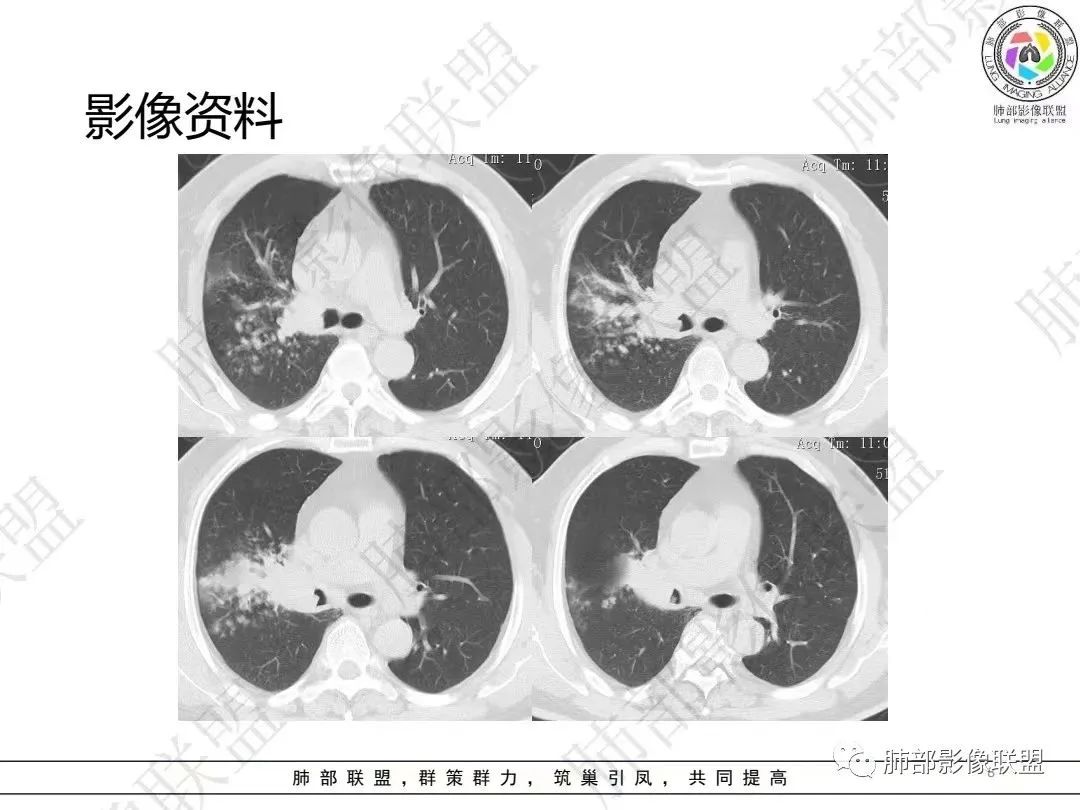 影像PPT - 【病例】大支气管内肿瘤的异类-8 影像PPT - 【病例】大支气管内肿瘤的异类-8