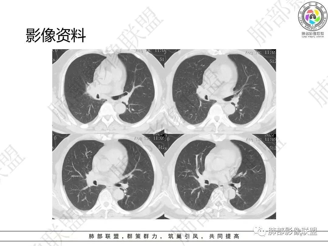 影像PPT - 【病例】大支气管内肿瘤的异类-9 影像PPT - 【病例】大支气管内肿瘤的异类-9