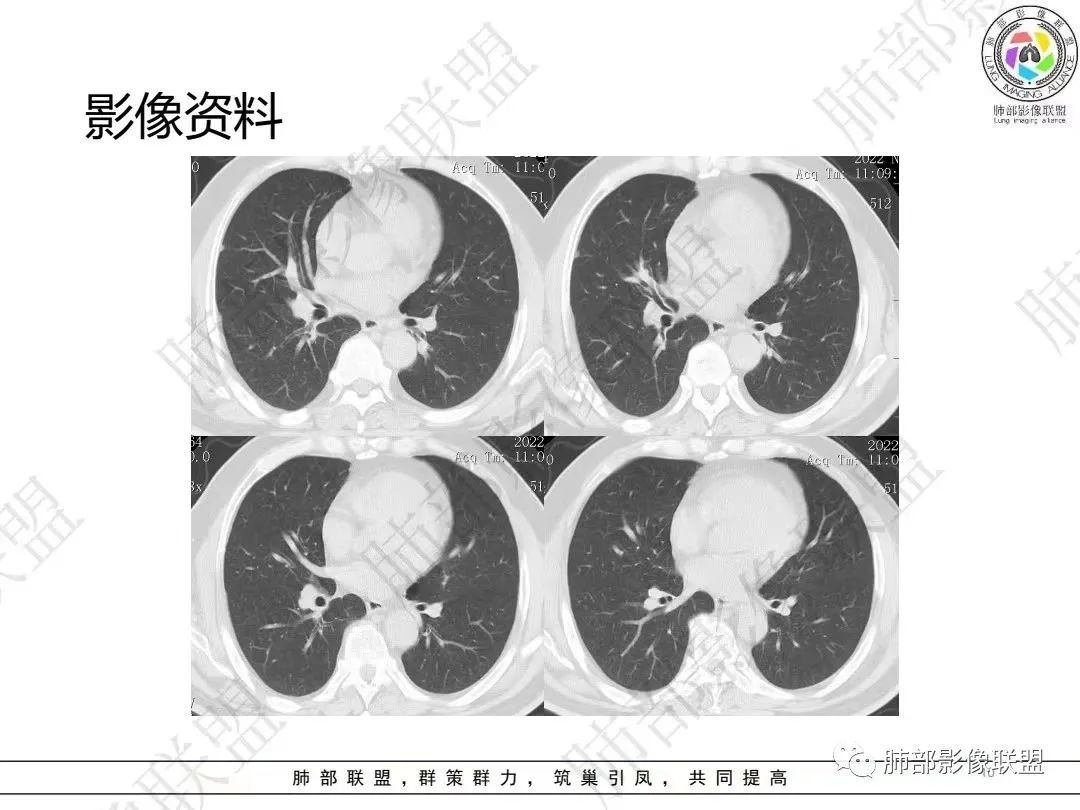 影像PPT - 【病例】大支气管内肿瘤的异类-10 影像PPT - 【病例】大支气管内肿瘤的异类-10
