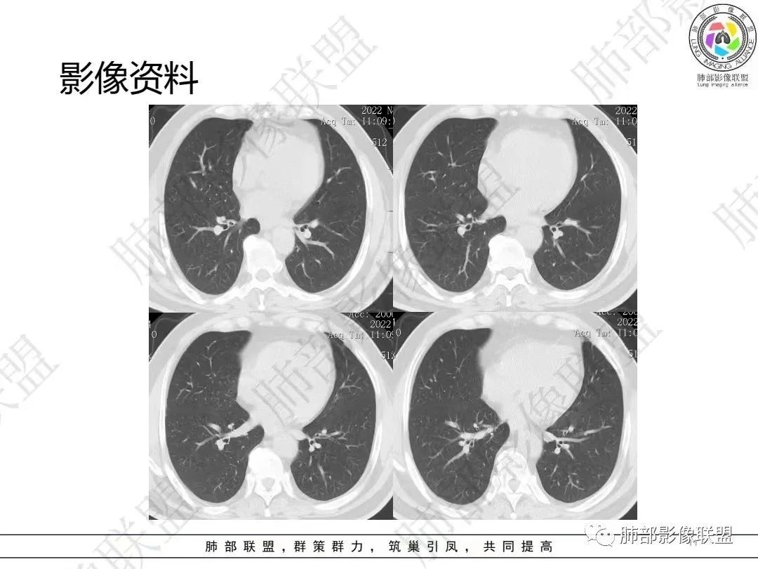 影像PPT - 【病例】大支气管内肿瘤的异类-11 影像PPT - 【病例】大支气管内肿瘤的异类-11