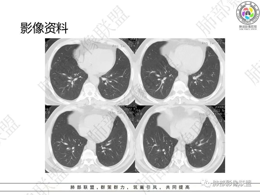 影像PPT - 【病例】大支气管内肿瘤的异类-12 影像PPT - 【病例】大支气管内肿瘤的异类-12