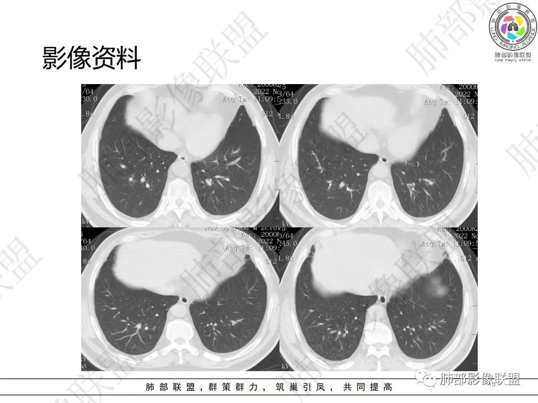 影像PPT - 【病例】大支气管内肿瘤的异类-13 影像PPT - 【病例】大支气管内肿瘤的异类-13