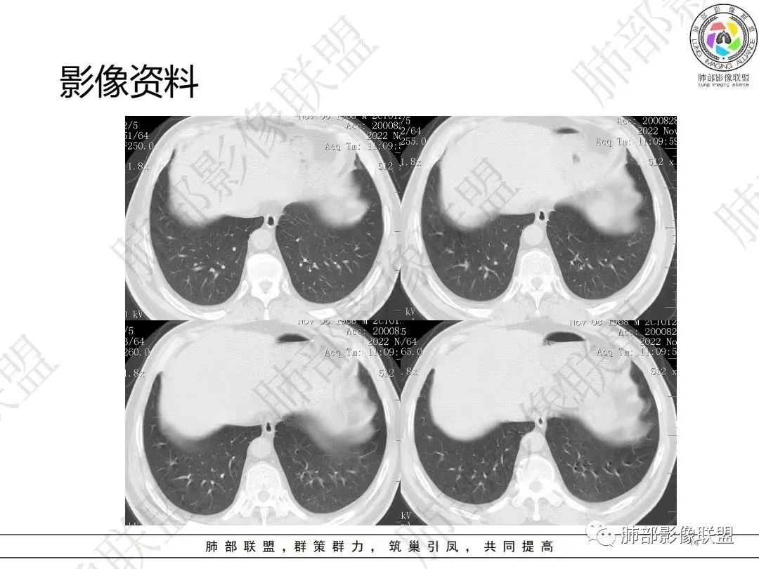 影像PPT - 【病例】大支气管内肿瘤的异类-14 影像PPT - 【病例】大支气管内肿瘤的异类-14