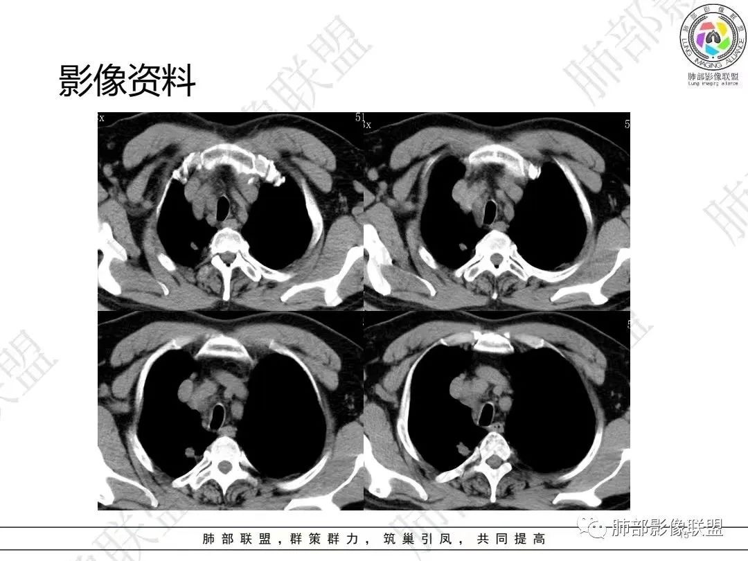 影像PPT - 【病例】大支气管内肿瘤的异类-15 影像PPT - 【病例】大支气管内肿瘤的异类-15