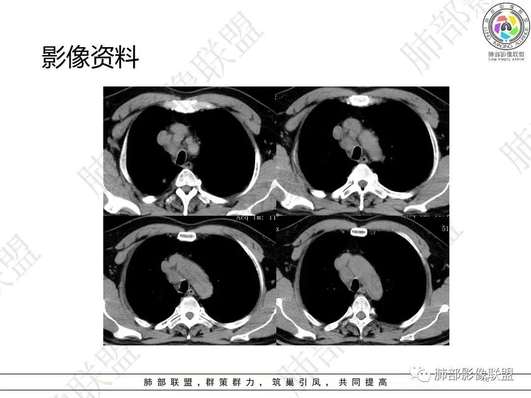 影像PPT - 【病例】大支气管内肿瘤的异类-16 影像PPT - 【病例】大支气管内肿瘤的异类-16