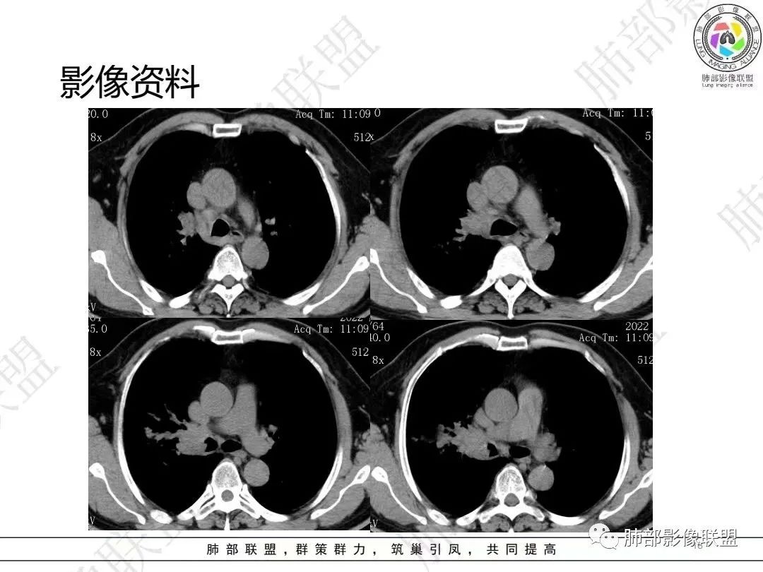 影像PPT - 【病例】大支气管内肿瘤的异类-18 影像PPT - 【病例】大支气管内肿瘤的异类-18