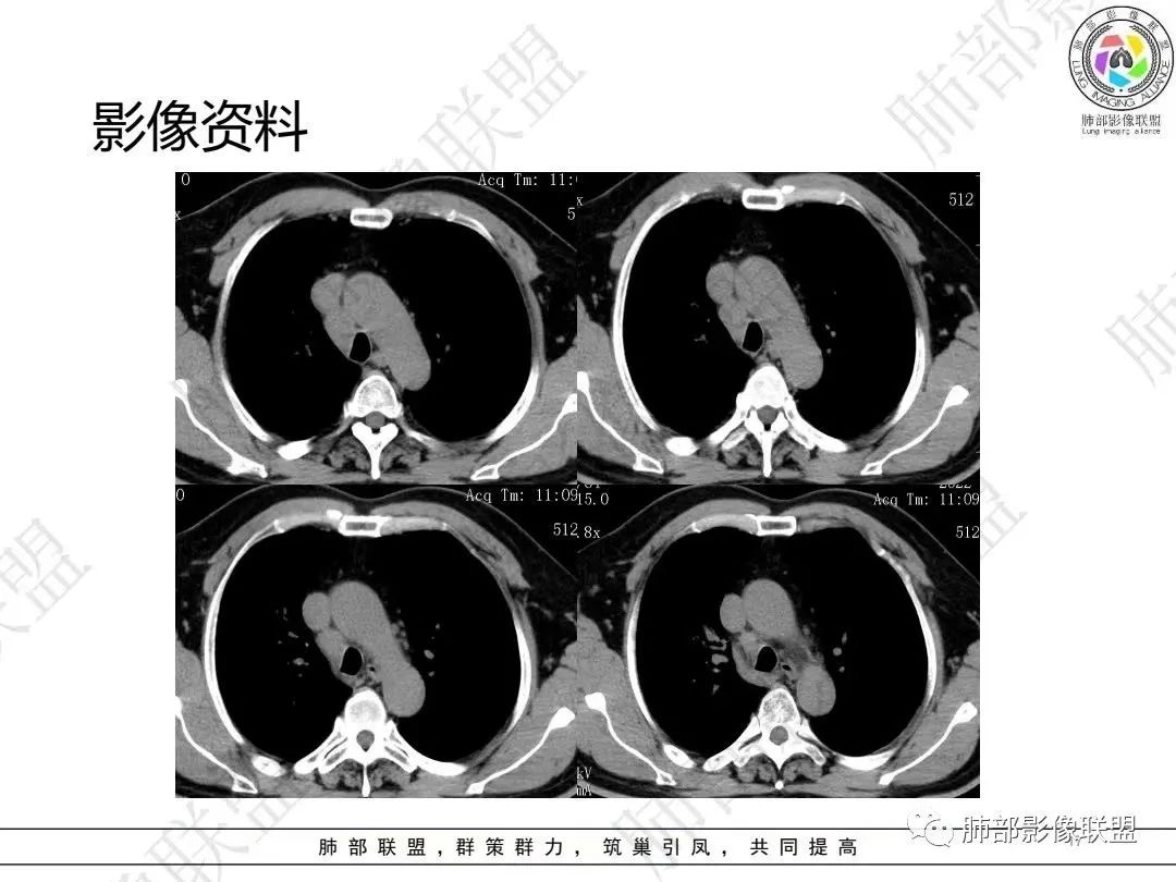 影像PPT - 【病例】大支气管内肿瘤的异类-17 影像PPT - 【病例】大支气管内肿瘤的异类-17