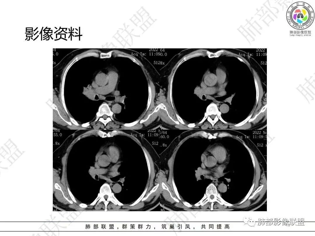 影像PPT - 【病例】大支气管内肿瘤的异类-19 影像PPT - 【病例】大支气管内肿瘤的异类-19