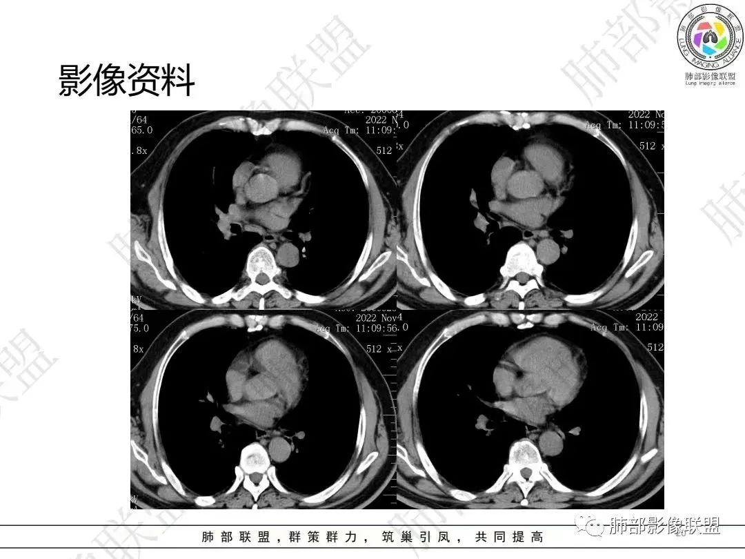 影像PPT - 【病例】大支气管内肿瘤的异类-20 影像PPT - 【病例】大支气管内肿瘤的异类-20