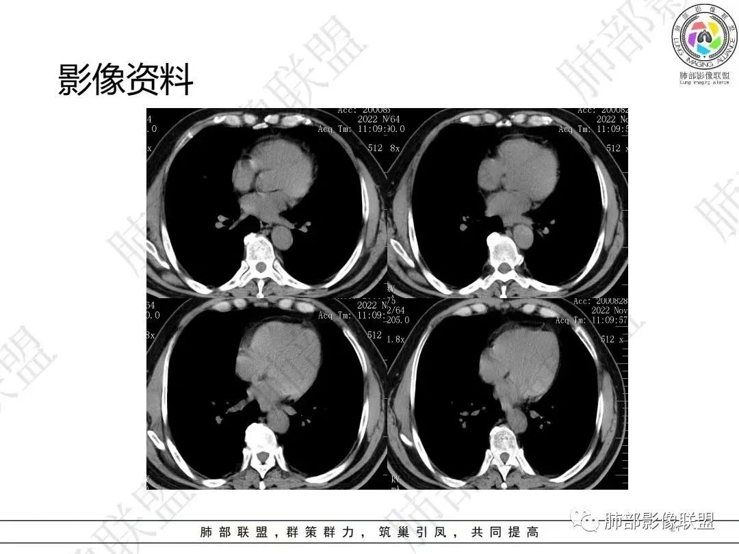 影像PPT - 【病例】大支气管内肿瘤的异类-21 影像PPT - 【病例】大支气管内肿瘤的异类-21