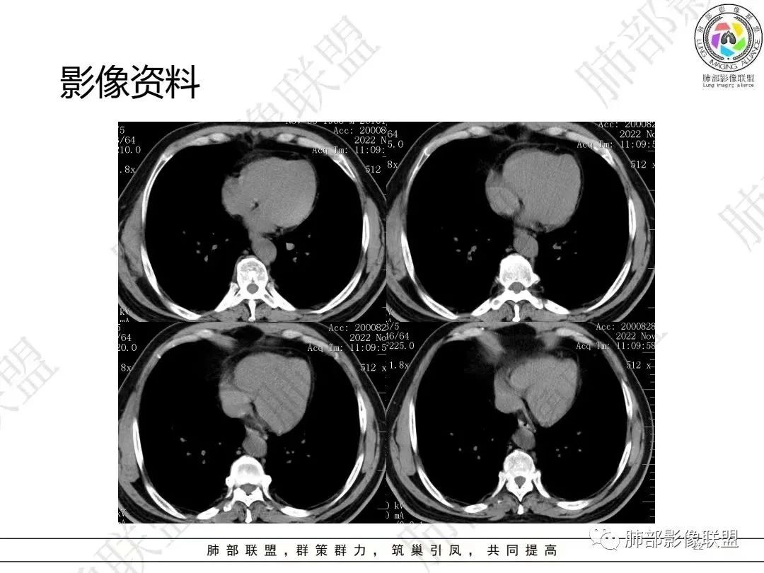 影像PPT - 【病例】大支气管内肿瘤的异类-22 影像PPT - 【病例】大支气管内肿瘤的异类-22