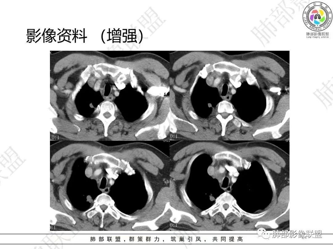 影像PPT - 【病例】大支气管内肿瘤的异类-24 影像PPT - 【病例】大支气管内肿瘤的异类-24